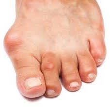 hallux-valgus-3